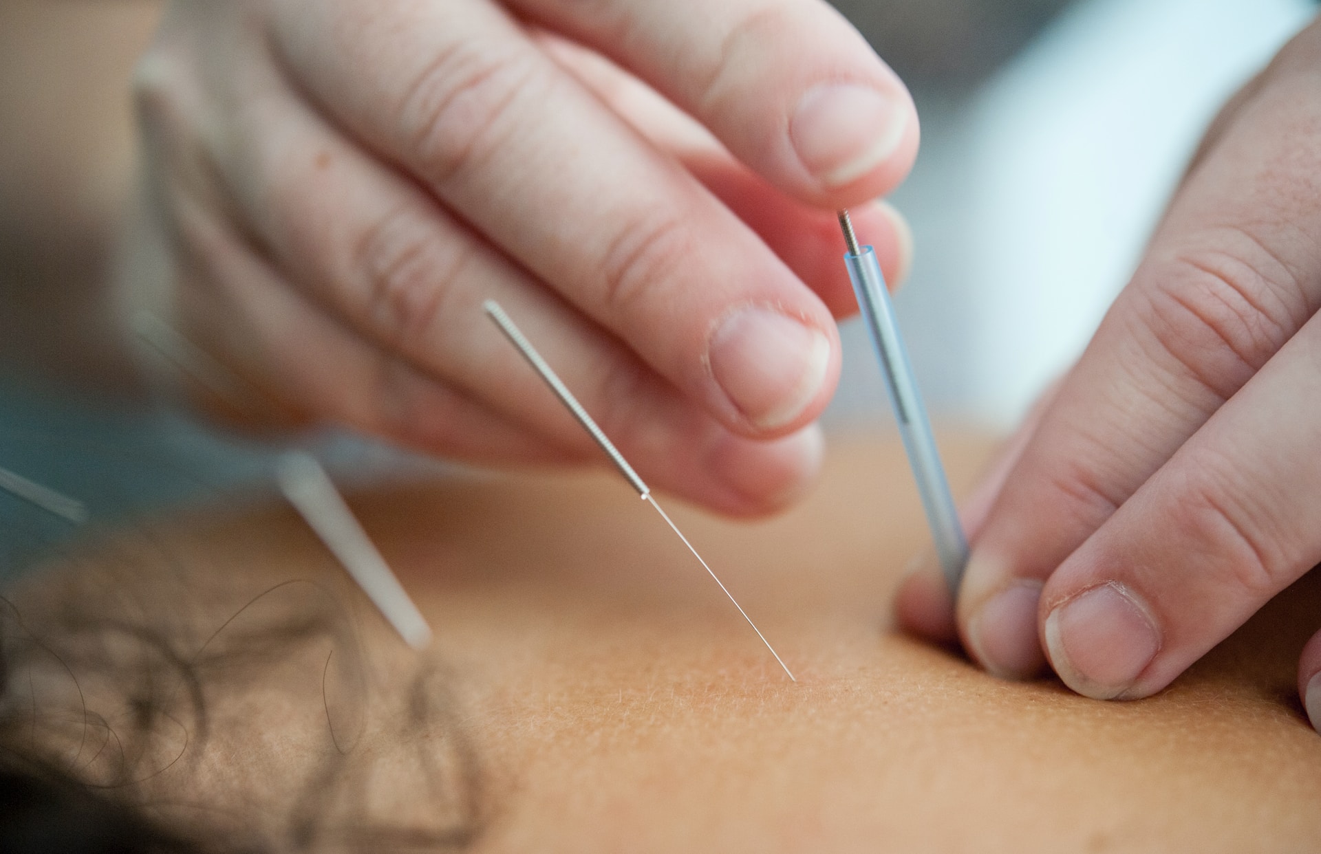 Someone receiving acupuncture treatment