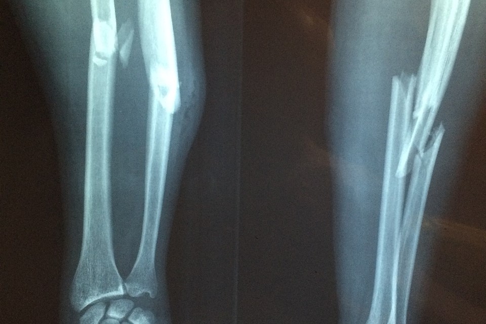 An x-ray of a fractured arm