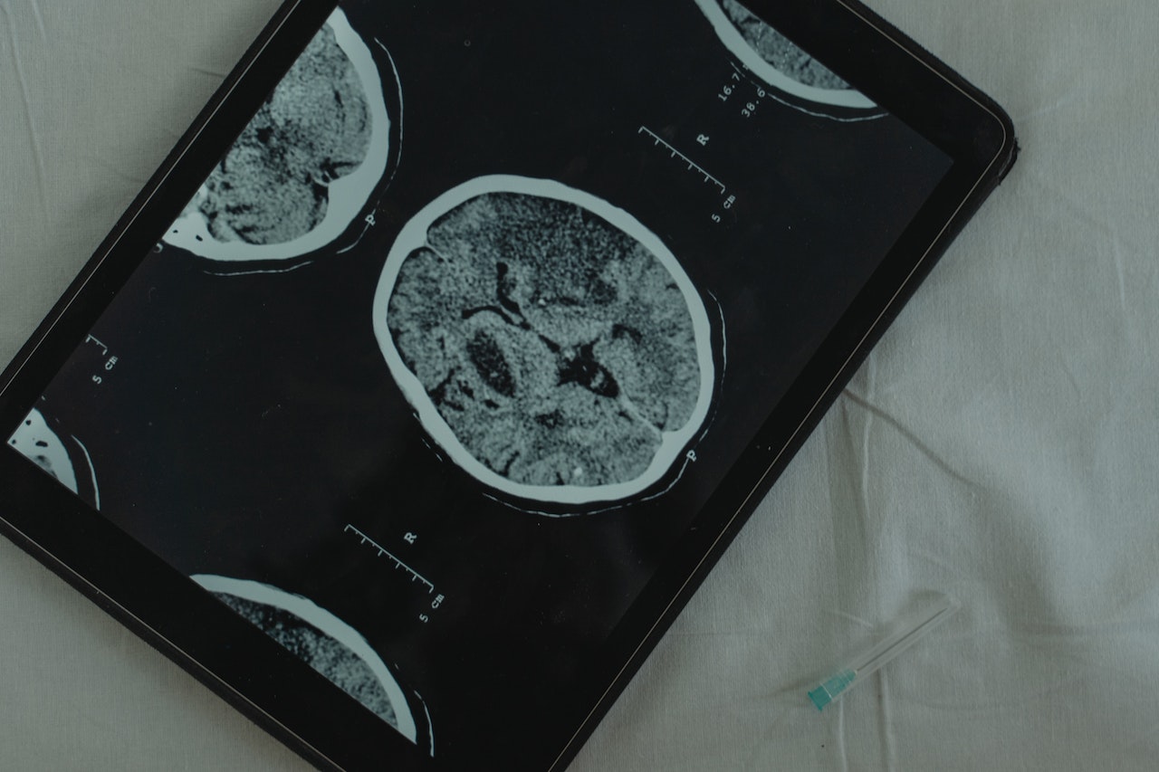 A brain scan image