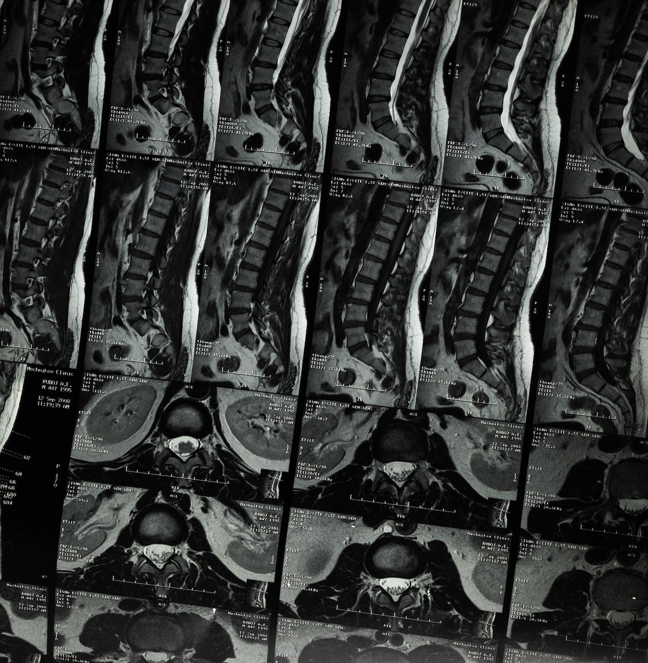 x ray of spine