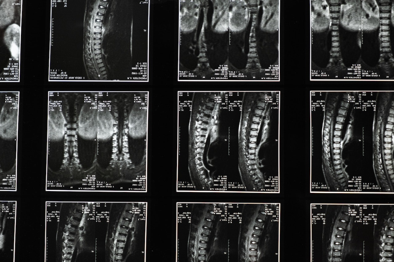 a number of spine scans